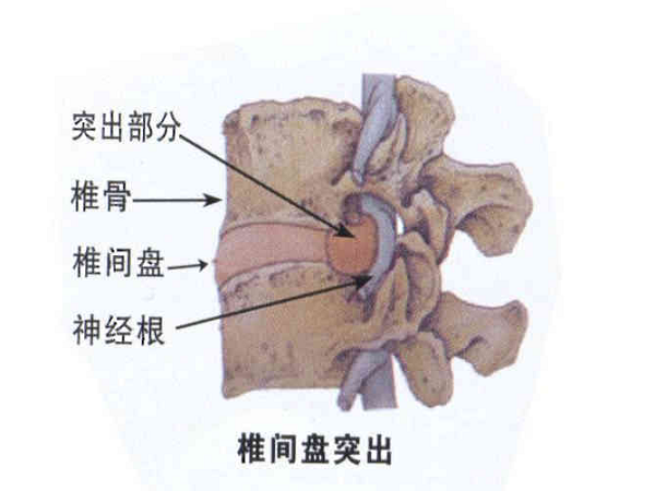 椎间盘突出 椎间盘突出
