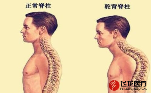 脊柱健康,不向生活“低头” 脊柱健康,不向生活“低头”