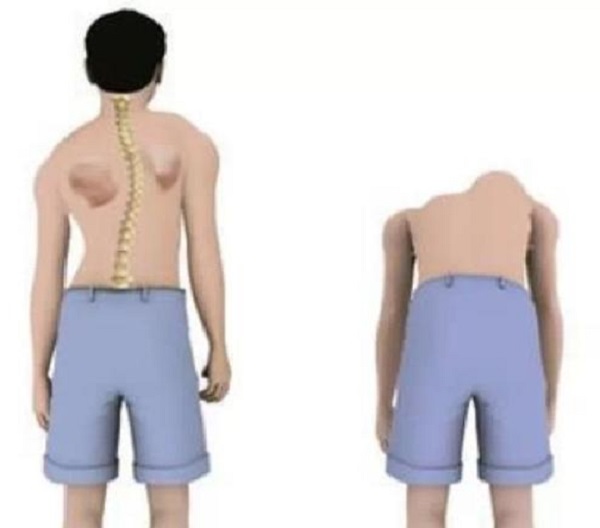 脊柱康复 脊柱康复