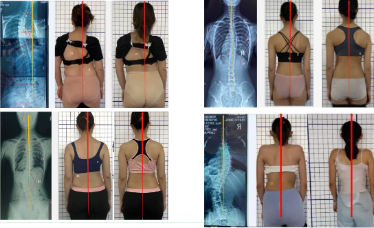 脊柱侧弯治疗 脊柱侧弯治疗