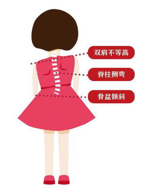 脊柱侧弯弯曲异常