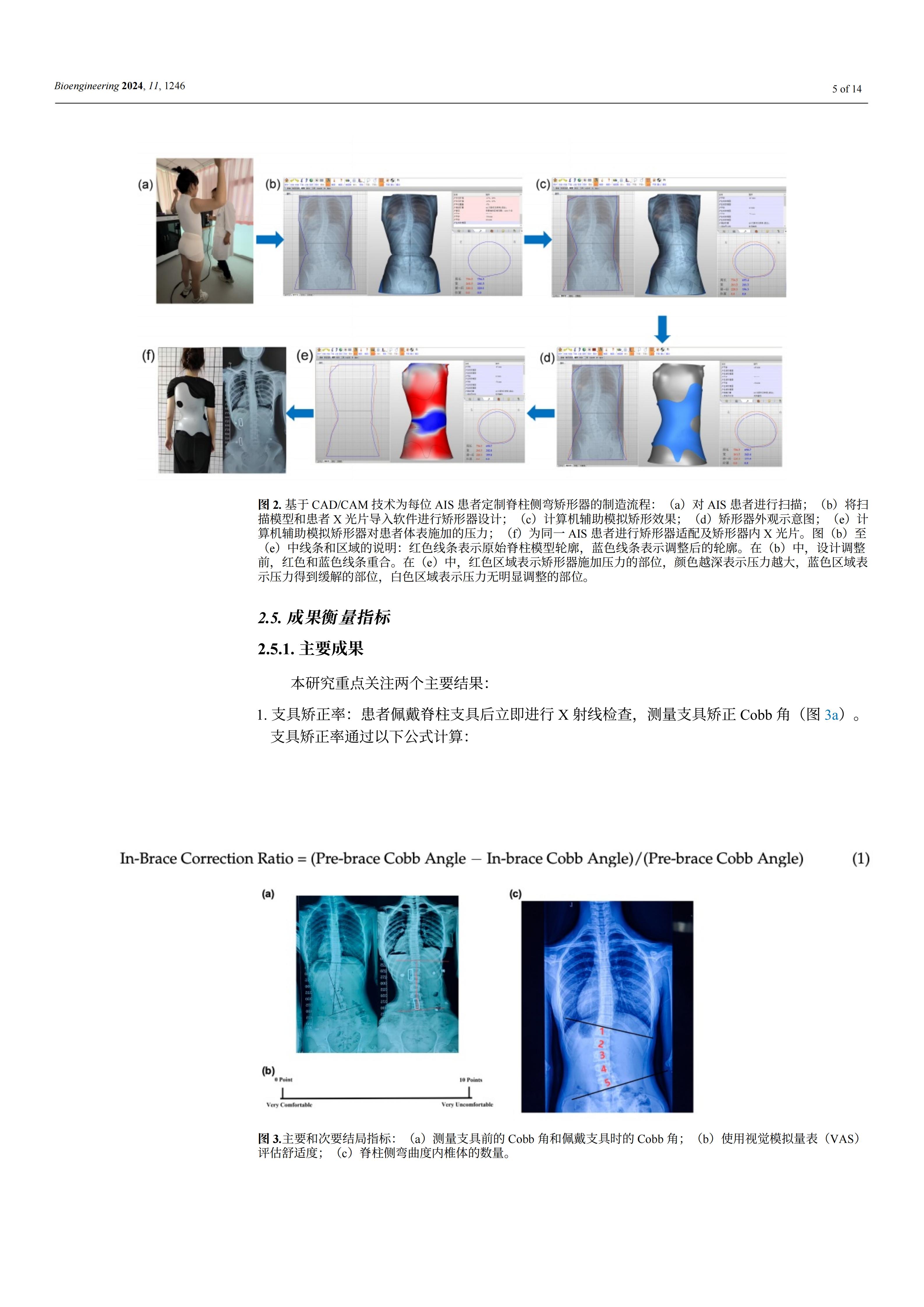 使用新型3D脊柱减压和矫正装置能够显著提高青少年特发性脊柱侧弯患者佩戴支具时的矫正效果和舒适度